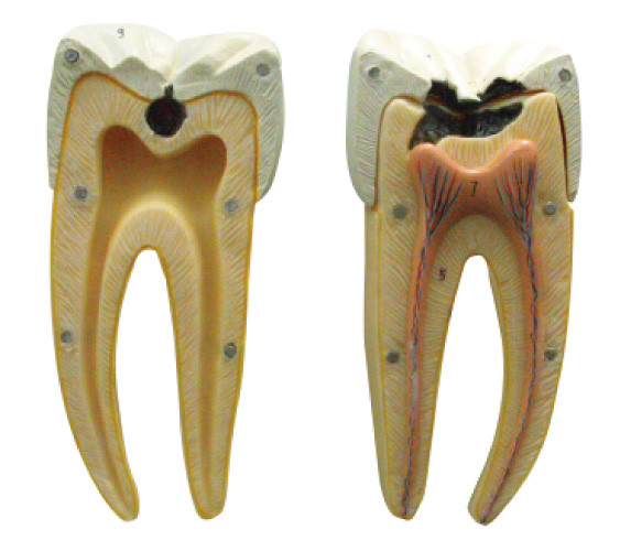 In der Initiale und in den fortgeschrittenen Stadien des Zahnkaries-Modells für das Lernen und die Ausbildung