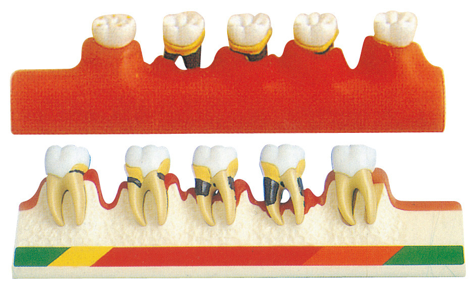 Parodontalerkrankungs-Modell umfaßt 5 Teile für die zahnmedizinische Schulausbildung