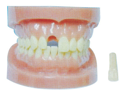 Abnehmbares Zahn-Modell ohne Wurzel für Krankenhäuser und zahnmedizinisches Verhinderungs-Training
