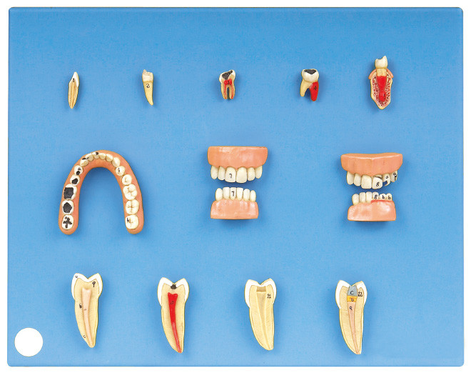 Zahnmedizinisches Krankheits-Modell gemacht von modernem PVC für Praktikum und die Studenten-Ausbildung