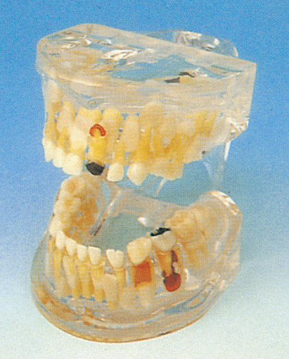 Menschliches Zahn-Modell/klare Pathologie von Milch-Zähnen modellieren für die zahnmedizinische Schulausbildung