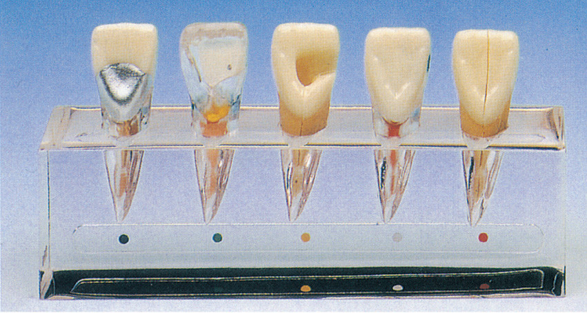 Klinisches Zahnerkrankungs-Reihen-Modell über 5 Teile für die zahnmedizinische Schulausbildung