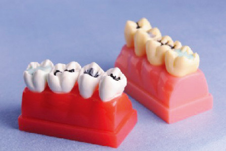 Menschliches Zahn-Modell für Dichtungsmittel-und Einlegearbeit-Demonstrations-Modell von 4mal lebensgroß