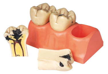Zergliedertes menschliches Zahn-Modell der zahnmedizinischen Krankheit für Praktikum und die Studenten-Ausbildung
