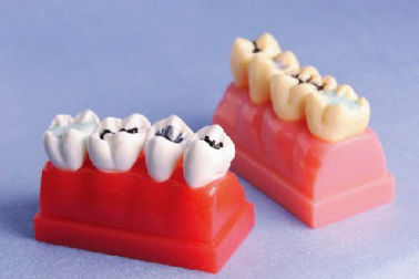 Menschliches Zahn-Modell für Dichtungsmittel-und Einlegearbeit-Demonstrations-Modell von 4mal lebensgroß